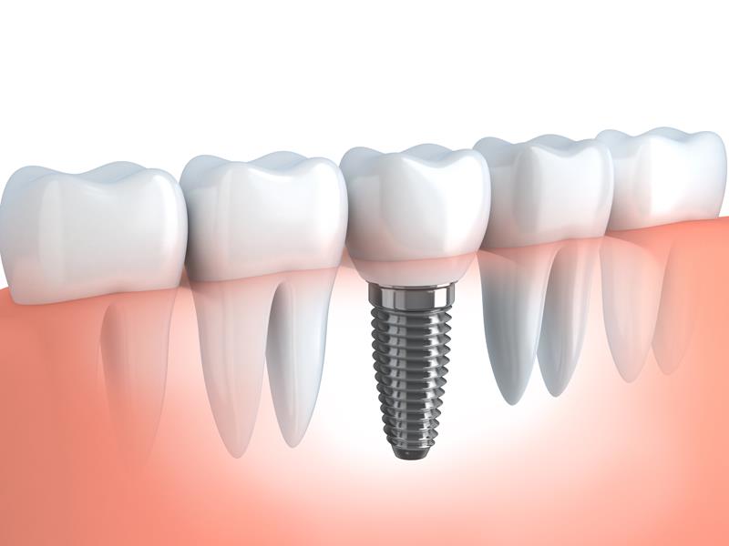Dental Implants Tulare, CA,
