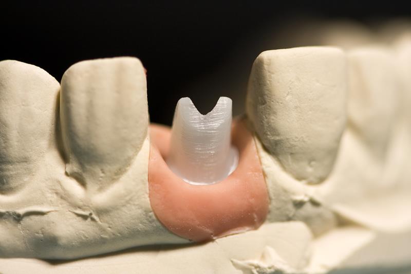 Implant Restoration Tulare, CA,