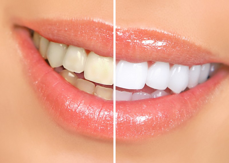 Teeth Whitening Tulare, CA,